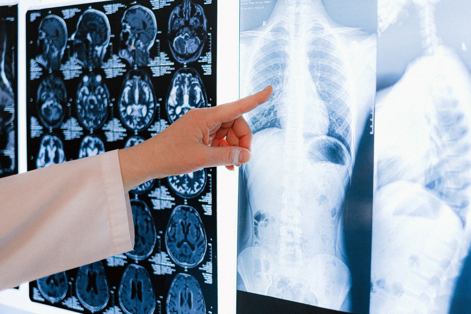 Profesional de la salud señalando una radiografía de tórax junto a resonancias cerebrales en un visor de sala de lectura de imágenes médicas